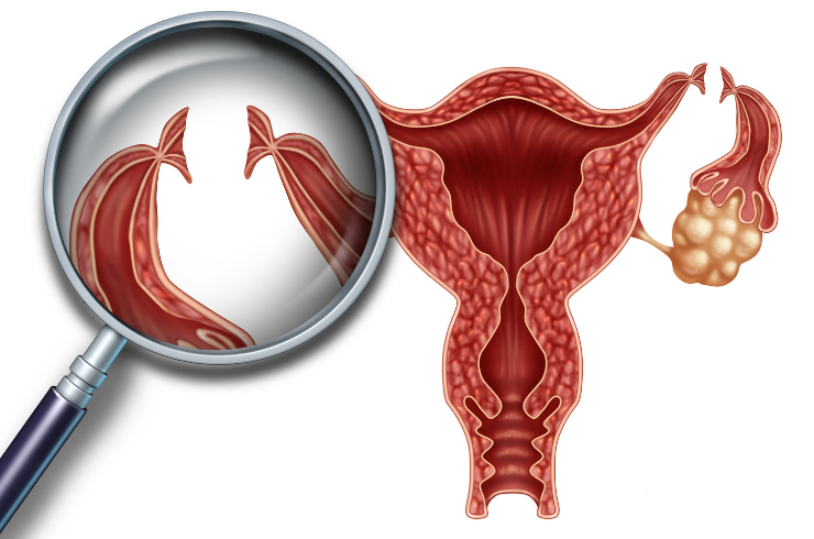 Tubectomy