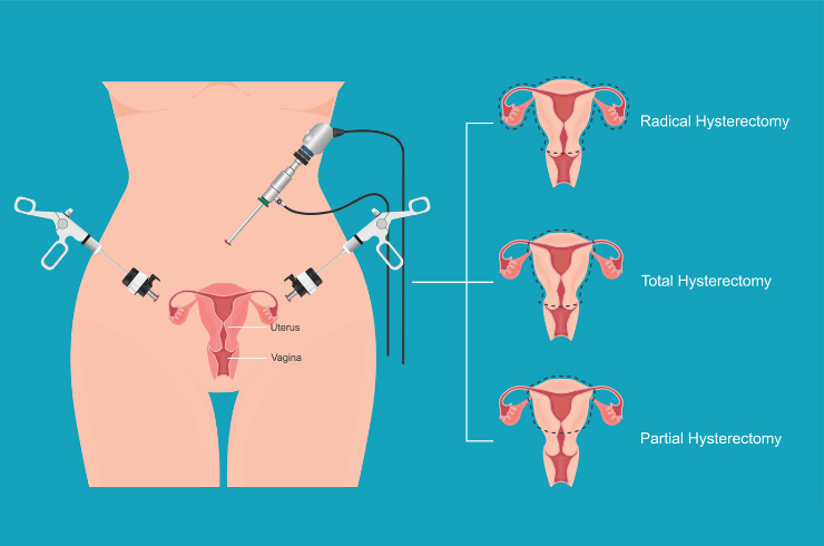 Hysterectomy